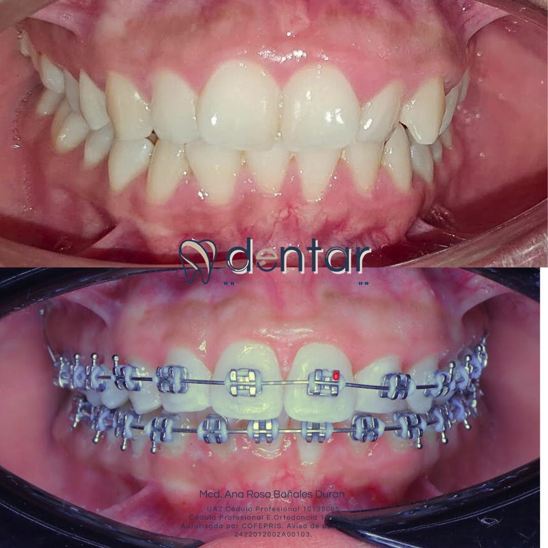 Ortodoncia integral superior e inferior